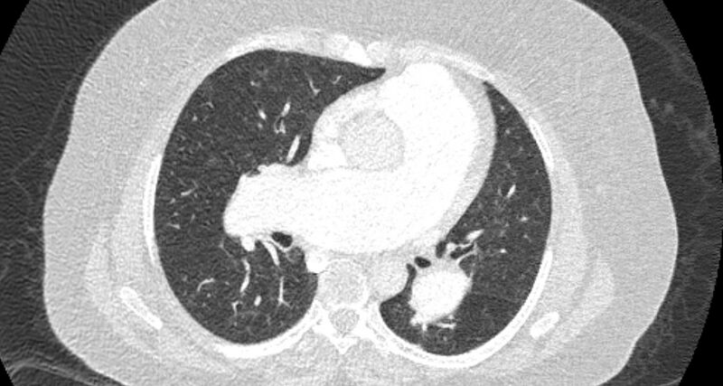 File:Accessory right inferior hepatic vein (Radiopaedia 65245-74259 Axial lung window 34).jpg