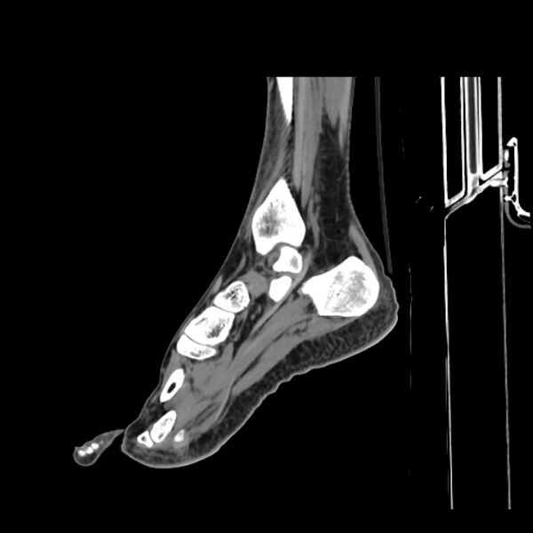 File:Accessory soleus muscle (Radiopaedia 61069-68943 Sagittal non-contrast 28).jpg
