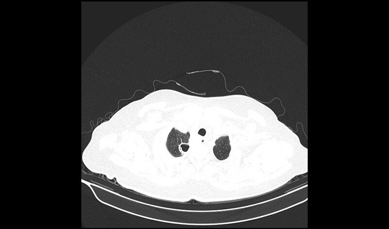 File:Acquired tracheo-esophageal fistula (Radiopaedia 51356-57103 Axial lung window 4).jpg
