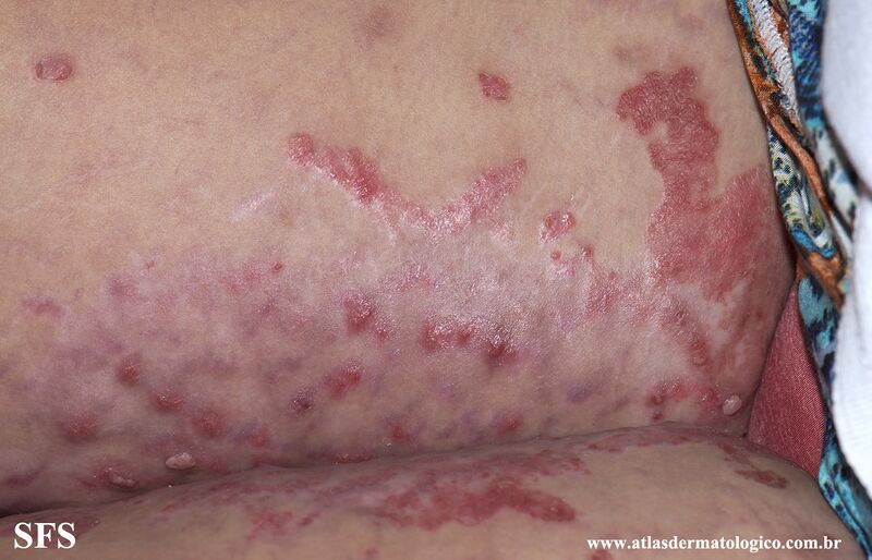 File:Acrodermatitis Enteropathica (Dermatology Atlas 48).jpg