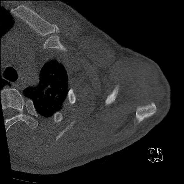 File:Acromioclavicular joint dissociation - type IV (Radiopaedia 64411-73216 Axial bone window 14).jpg
