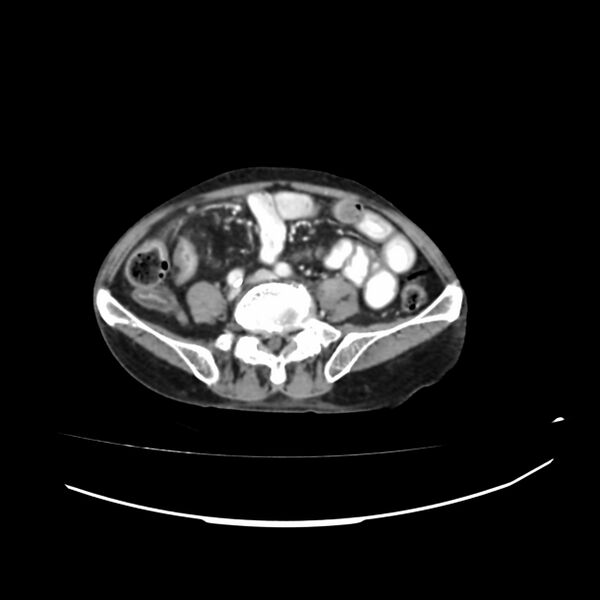 File:Acute-on-chronic Crohn disease with enteroenteric fistula (Radiopaedia 66686-75987 B 29).jpg