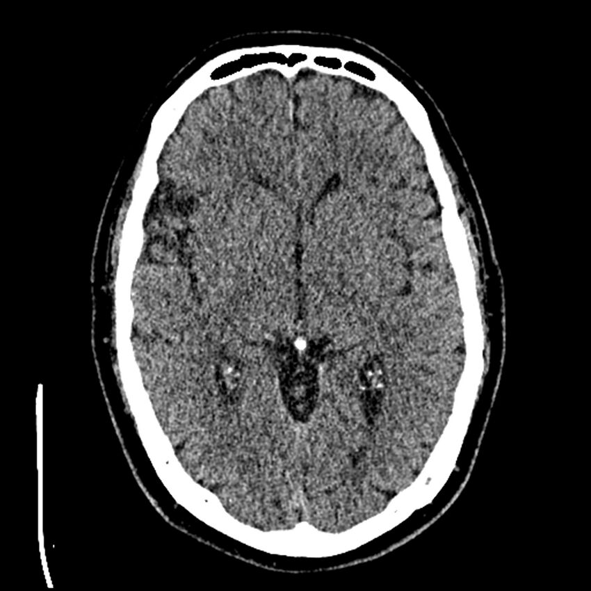 Acute A3 occlusion with ACA ischemic penumbra (CT perfusion) (Radiopaedia 72036-82525 Axial non-contrast thins 26).jpg