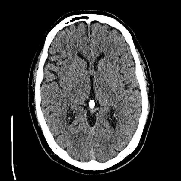 File:Acute A3 occlusion with ACA ischemic penumbra (CT perfusion) (Radiopaedia 72036-82525 Axial non-contrast thins 30).jpg