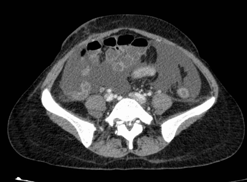 File:Acute Budd-Chiari syndrome (Radiopaedia 60858-68638 Axial C+ portal venous phase 210).jpg