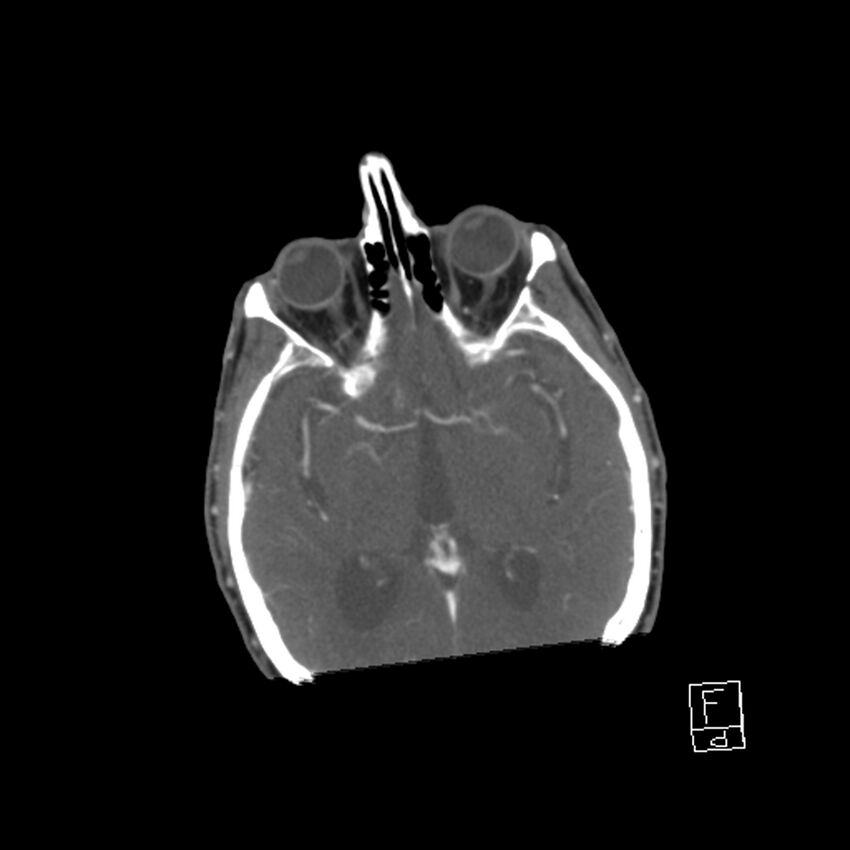 Acute ICA ischemic penumbra due to high-grade CCA stenosis (CT perfusion) (Radiopaedia 72038-82530 Axial C+ arterial phase 5).jpg
