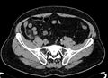 Acute appendicitis (Radiopaedia 13030-13091 Axial non-contrast 36).jpg