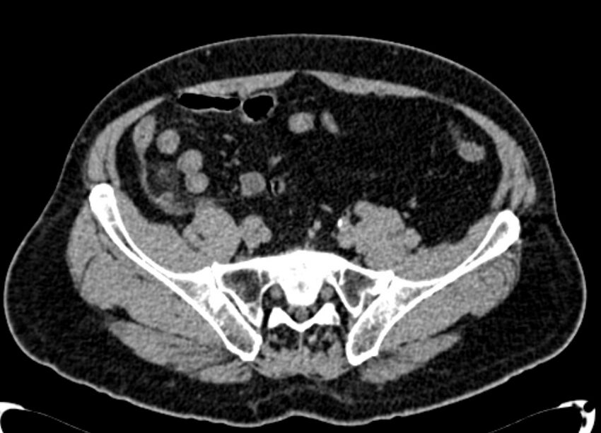 Acute appendicitis (Radiopaedia 13030-13091 Axial non-contrast 36).jpg