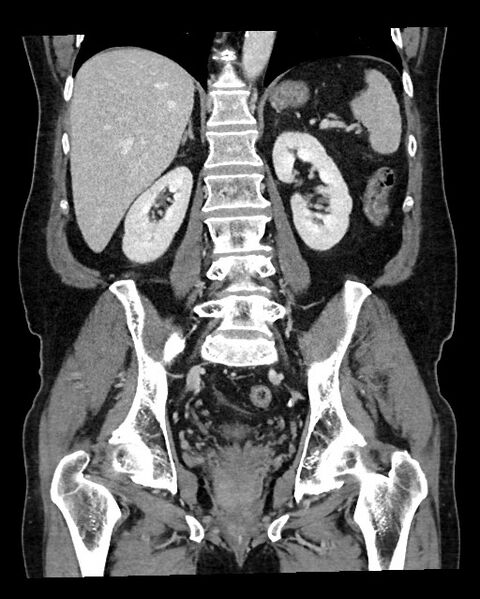 File:Acute appendicitis - large appendicoliths (Radiopaedia 61805-69820 Coronal C+ portal venous phase 88).jpg
