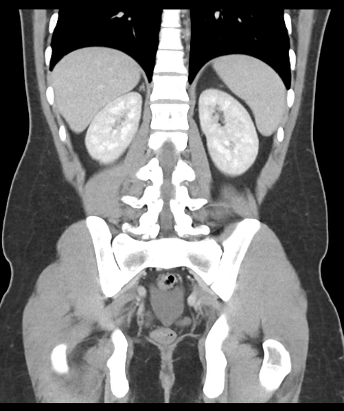 File:Acute appendicitis with appendicoliths (Radiopaedia 50186-55532 Coronal C+ portal venous phase 39).png