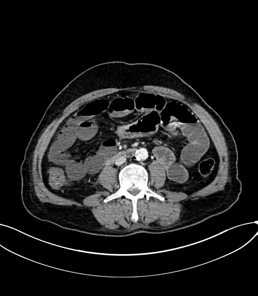 Acute arterial mesenteric ischemia (Radiopaedia 78238-90828 Axial C+ portal venous phase 73).jpg