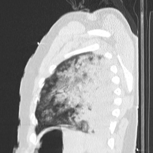 File:Acute aspiration pneumonitis (Radiopaedia 33605-34703 Sagittal lung window 71).jpg