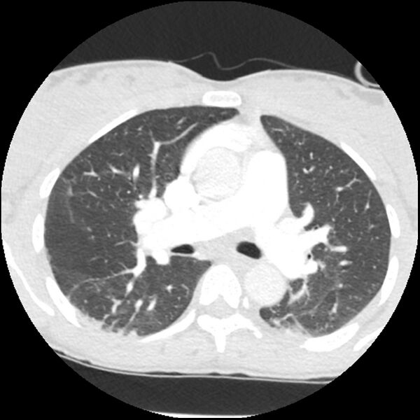 File:Acute chest syndrome - sickle cell disease (Radiopaedia 42375-45499 Axial lung window 82).jpg