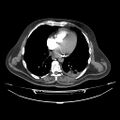 Acute heart failure (CT) (Radiopaedia 79835-93075 Axial C+ arterial phase 30).jpg