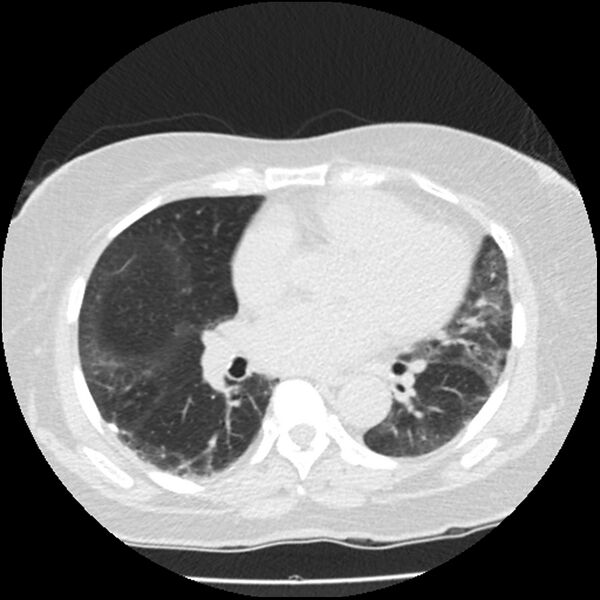 File:Acute interstitial pneumonitis (Radiopaedia 45404-49444 Axial lung window 60).jpg