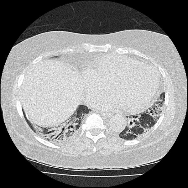 File:Acute interstitial pneumonitis (Radiopaedia 45404-49452 Axial lung window 65).jpg