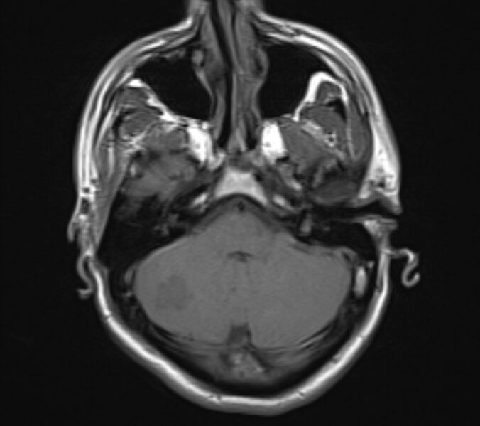 File:Acute ischemic stroke - posterior circulation territory (Radiopaedia 77670-89880 Axial T1 6).jpg