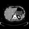 Acute myocardial infarction in CT (Radiopaedia 39947-42415 Axial C+ portal venous phase 30).jpg