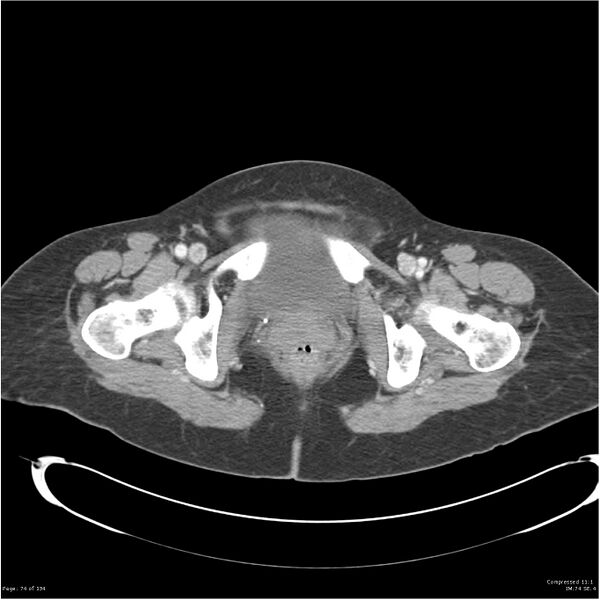 File:Acute pancreatitis (Radiopaedia 19136-19117 Axial C+ portal venous phase 43).jpg