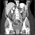 Acute pancreatitis (Radiopaedia 19136-19117 Coronal C+ portal venous phase 25).jpg