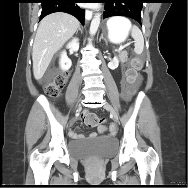 File:Acute pancreatitis (Radiopaedia 19136-19117 Coronal C+ portal venous phase 25).jpg