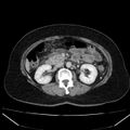 Acute pancreatitis - Balthazar C (Radiopaedia 26569-26714 Axial C+ portal venous phase 45).jpg