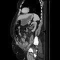 Acute pyelonephritis (Radiopaedia 25657-25837 Sagittal renal parenchymal phase 55).jpg
