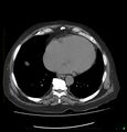 Acute renal failure post IV contrast injection- CT findings (Radiopaedia 47815-52559 Axial C+ portal venous phase 5).jpg