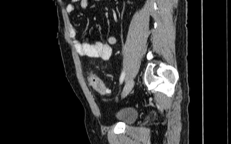 File:Acute sigmoid colon diverticulitis (Radiopaedia 55507-61976 Sagittal C+ portal venous phase 48).jpg