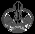Acute sinusitis (Radiopaedia 23161-23215 Axial bone window 21).jpg