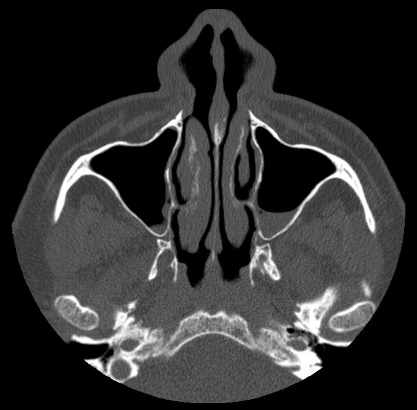 File:Acute sinusitis (Radiopaedia 23161-23215 Axial bone window 21).jpg