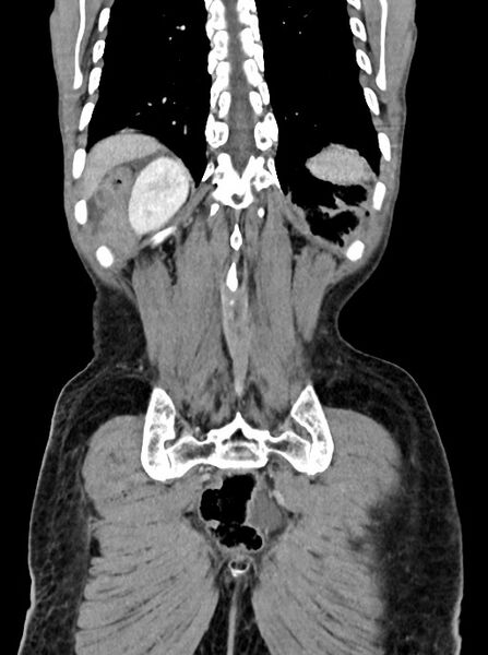 File:Acute small bowel (ileal) volvulus (Radiopaedia 71740-82139 Coronal C+ portal venous phase 95).jpg
