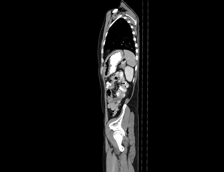 File:Addison disease (Radiopaedia 49318-54412 Sagittal C+ portal venous phase 14).jpg
