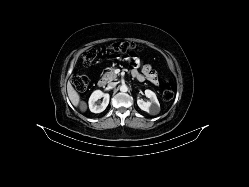 File:Adenocarcinoma of pancreas with hepatic metastasis (Radiopaedia 64332-73122 Axial C+ portal venous phase 39).jpg