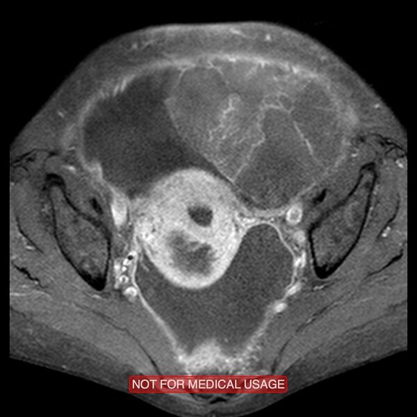File:Adenocarcinoma of the cervix (Radiopaedia 28373-28615 Axial T1 C+ fat sat 13).jpg