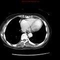 Adenocarcinoma of the colon (Radiopaedia 8191-9039 Axial liver window 6).jpg