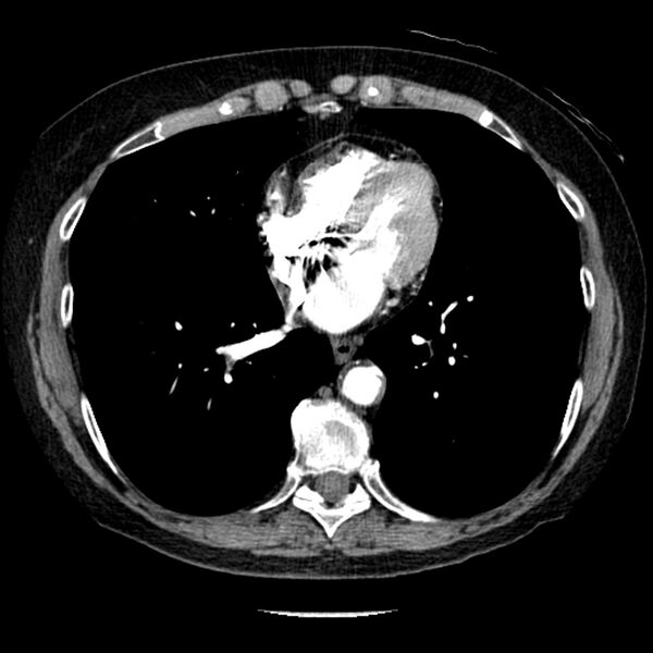 File:Adenocarcinoma of the lung (Radiopaedia 41015-43755 Axial C+ portal venous phase 78).jpg
