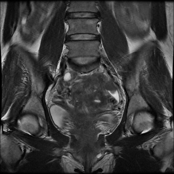 File:Adenomyosis on MRI (Radiopaedia 29328-29780 Coronal T2 7).jpg