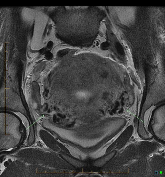 File:Adenomyosis uterus with hematometra (Radiopaedia 45779-50011 Coronal T2 8).jpg