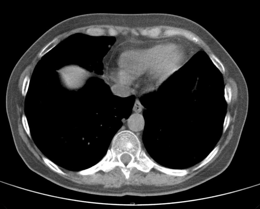 Adenosquamous lung carcinoma (Radiopaedia 22035-22030 non-contrast 46).jpg