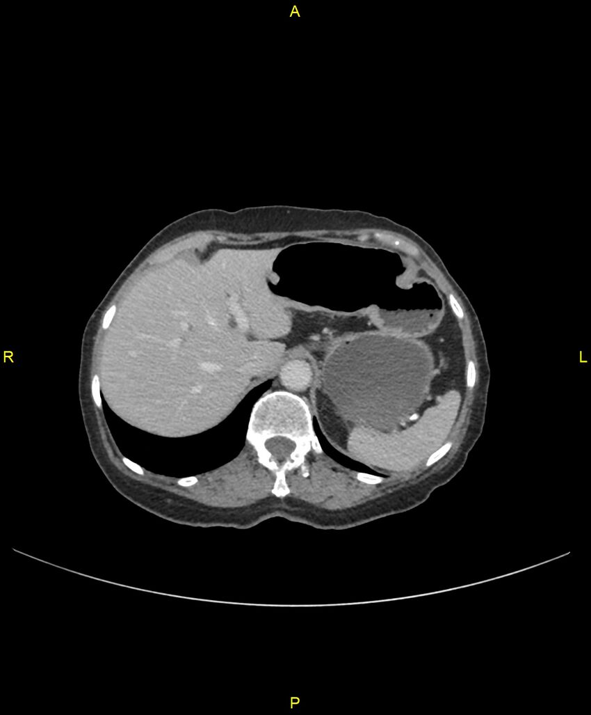Adhesional small bowel obstruction (Radiopaedia 85402-101024 Axial C+ portal venous phase 59).jpg