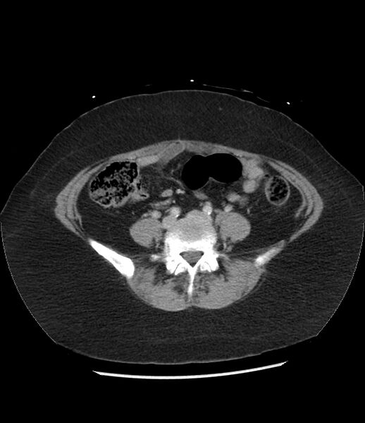 File:Adrenal cortical carcinoma with IVC invasion and thrombosis (Radiopaedia 34307-35597 Axial C+ portal venous phase 59).jpg