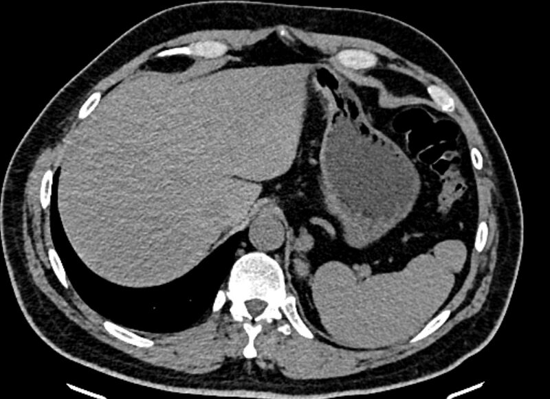File:Adrenal metastases (Radiopaedia 73082-83791 Axial non-contrast 31).jpg