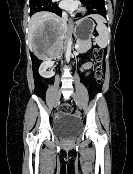 File:Adrenocortical carcinoma (Radiopaedia 87281-103569 Coronal C+ portal venous phase 57).jpg