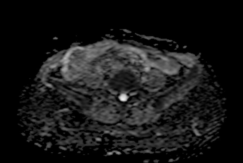 File:Adult granulosa cell tumor of the ovary (Radiopaedia 71581-81950 Axial ADC 4).jpg