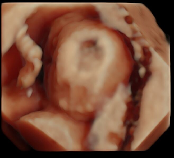 File:Alobar holoprosencephaly- prenatal ultrasound 1st trimester (Radiopaedia 58085).jpg