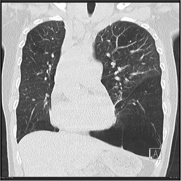 File:Alpha-1-antitrypsin deficiency (Radiopaedia 26537-26678 Coronal lung window 12).jpg