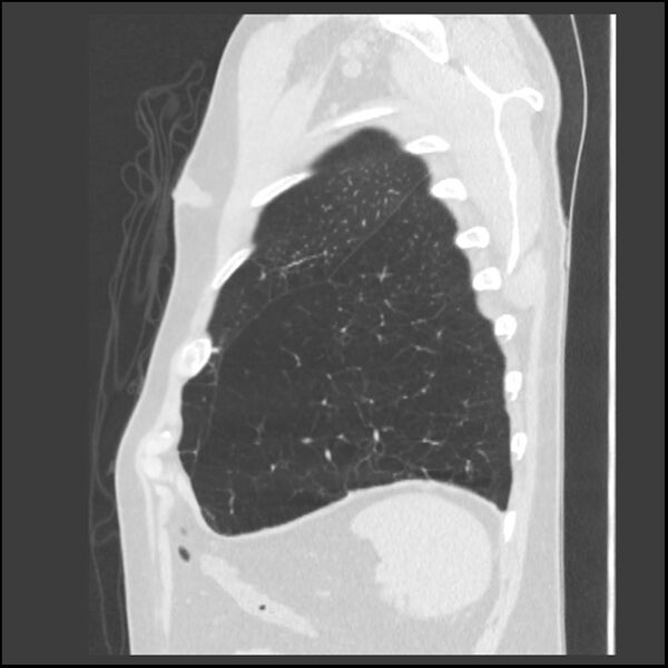 File:Alpha-1-antitrypsin deficiency (Radiopaedia 40993-43722 Sagittal lung window 39).jpg