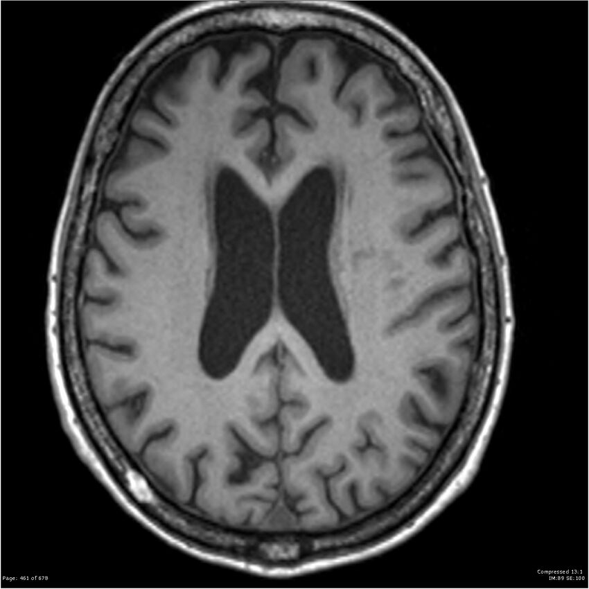 Alzheimer disease (Radiopaedia 22196-22226 Axial T1 41).jpg