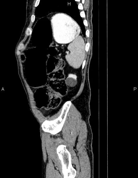 File:Ampullary adenocarcinoma (Radiopaedia 86093-102032 D 84).jpg